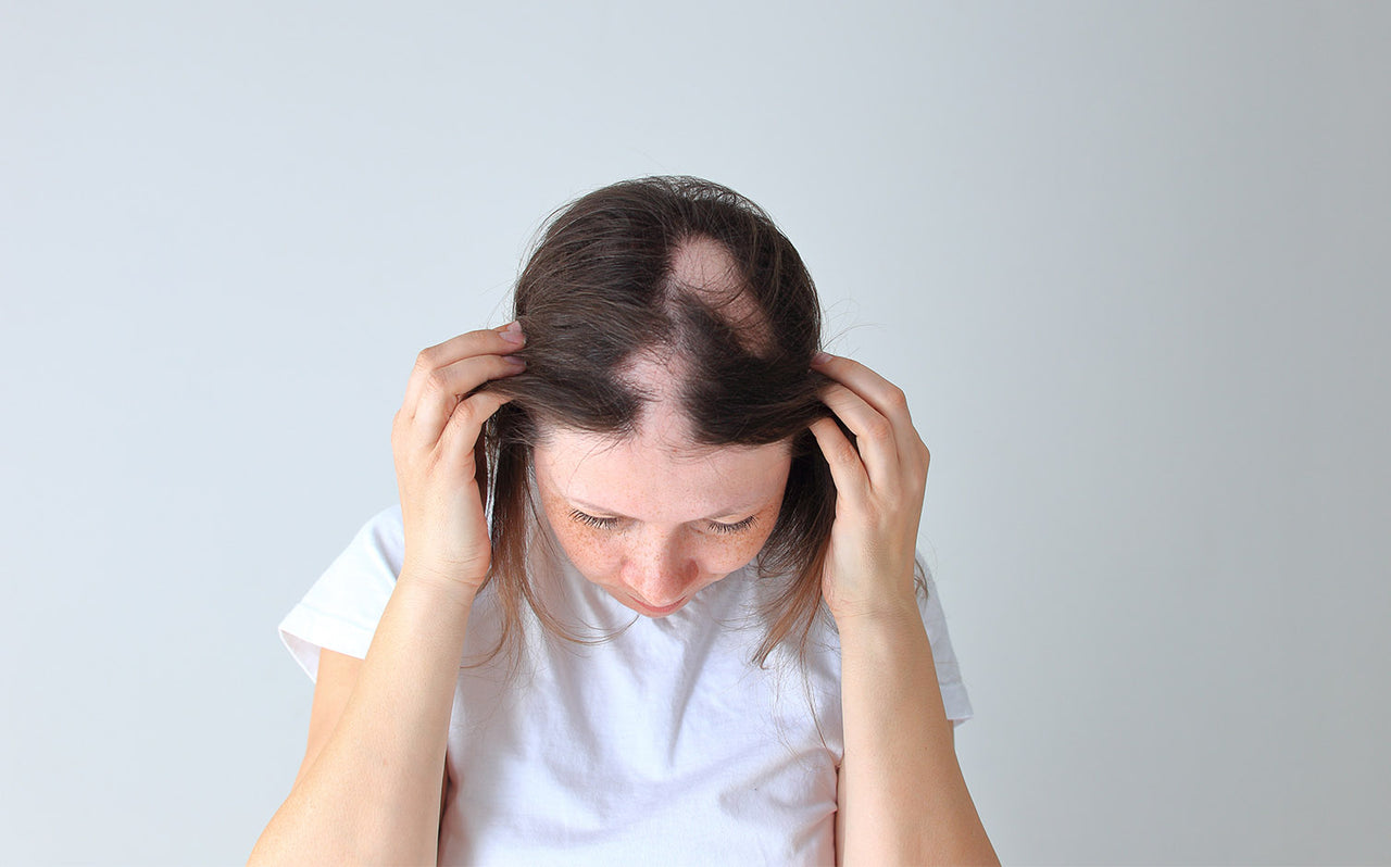 Alopecia: Tips on Finding Wigs and Styling Them