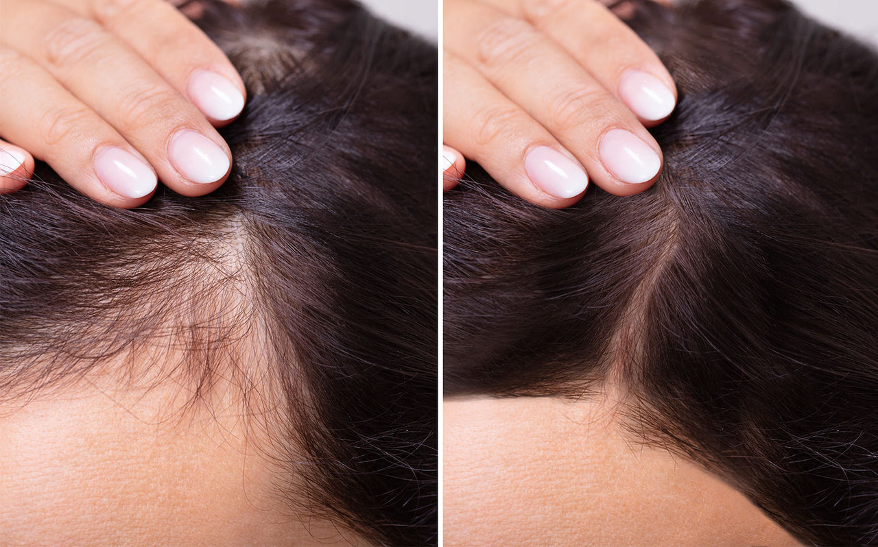 Preventing Hair Loss: How to Stop It